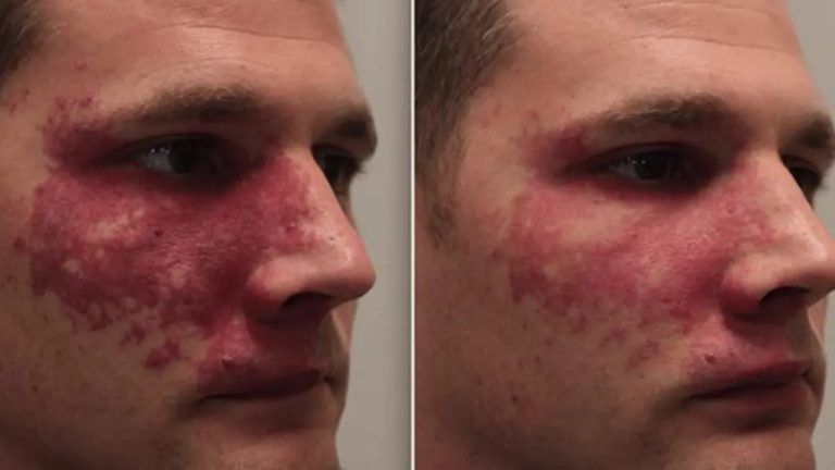 درمان ماه گرفتگی با لیزر