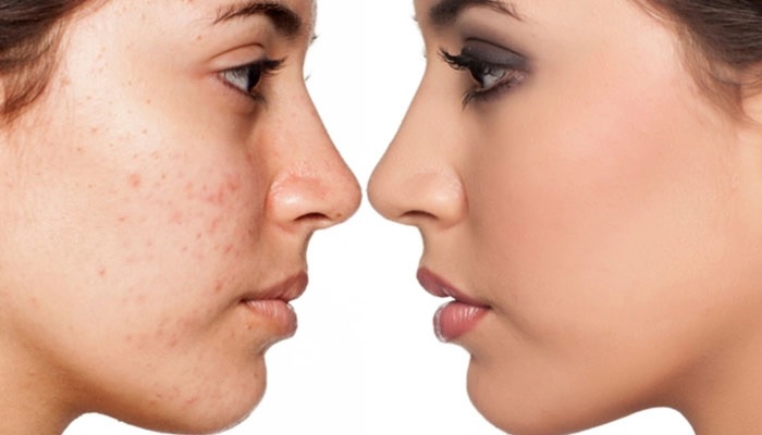 5 درمان سریع و موثر برای جای جوش