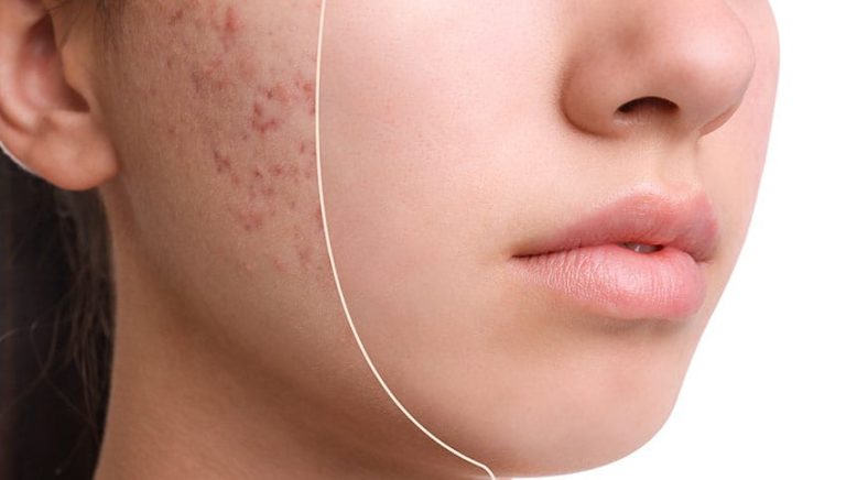 لایمیسایکلین و درمان جوش