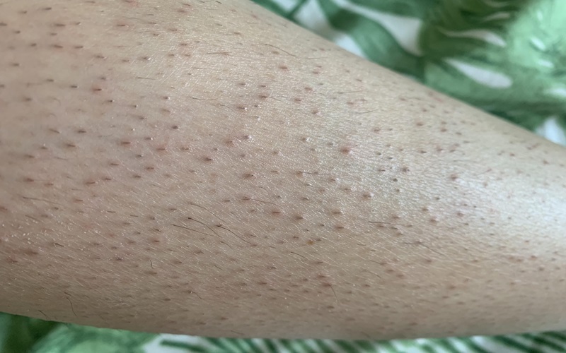 درمان موی زیر پوستی 1 علل ایجاد موی زیر پوستی