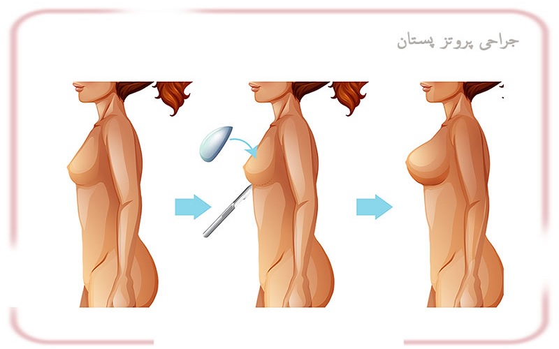 همه چیز درباره پروتز سینه 2 مراحل جراحی پروتز سینه