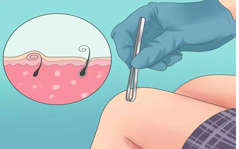 درمان موی زیر پوستی 2 روشهای درمان موی زیر پوستی