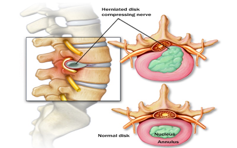 اوزون درمانی برای درمان دیسک کمر 2 روش تزریق پاراورتبرال اوزون