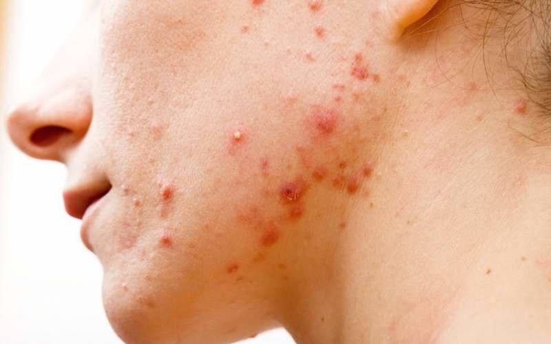 درمان مشکلات پوستی در پوست تیره 2 اصول اساسی در درمان مشکلات پوستی در پوست تیره