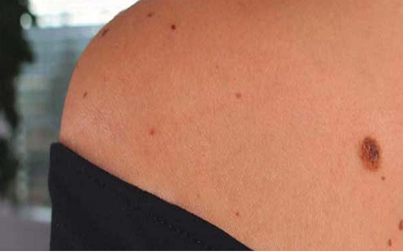 بررسی خال های بدن و اهمیت آن؛ چک کردن خال و علائم خطرناک 2 رنگ و اندازه خال