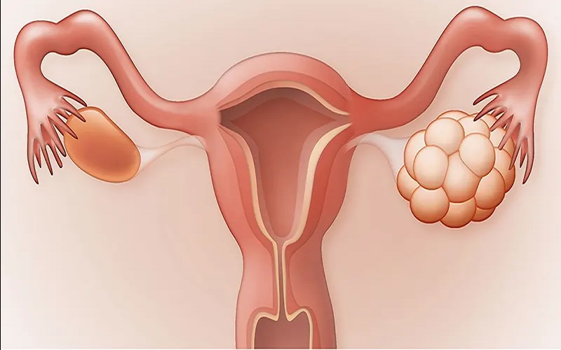 مدیریت تنبلی تخمدان با لیزر موهای زائد 2 ببب
