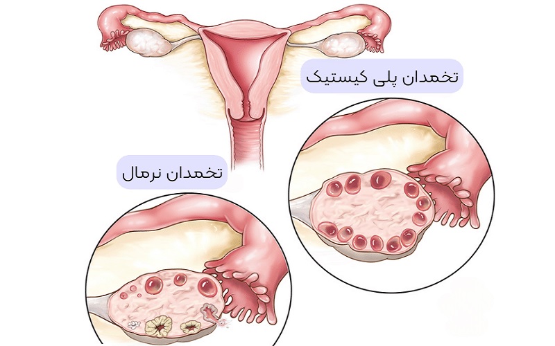 مدیریت تنبلی تخمدان با لیزر موهای زائد 3 ببببب 1