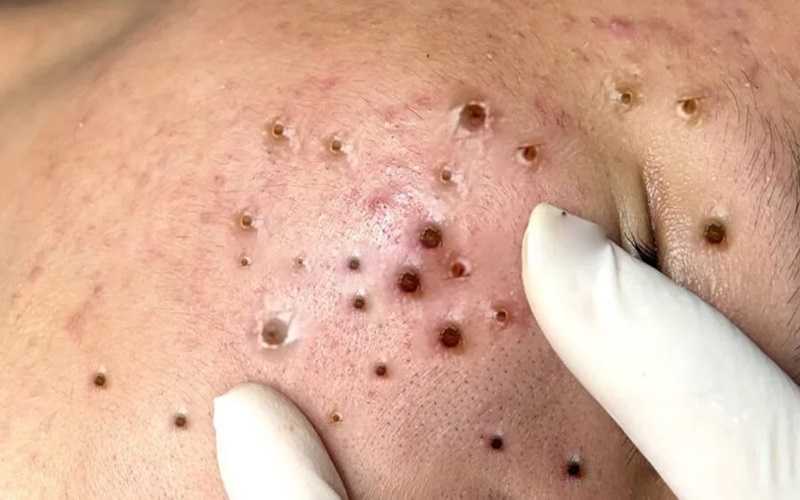 همه چیز درباره جوش سر سیاه و راههای درمان آن 1 جوش سر سیاه چیست؟