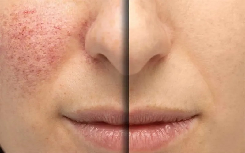 درمان ماه گرفتگی با لیزر 3 لیزر PDL برای ماه گرفتگیهای عروقی