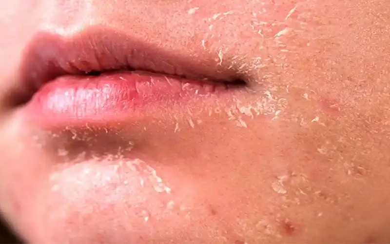 تاثیر وزن بر سلامت پوست 2 خشکی و تغییر رنگ پوست در اثر کمبود وزن