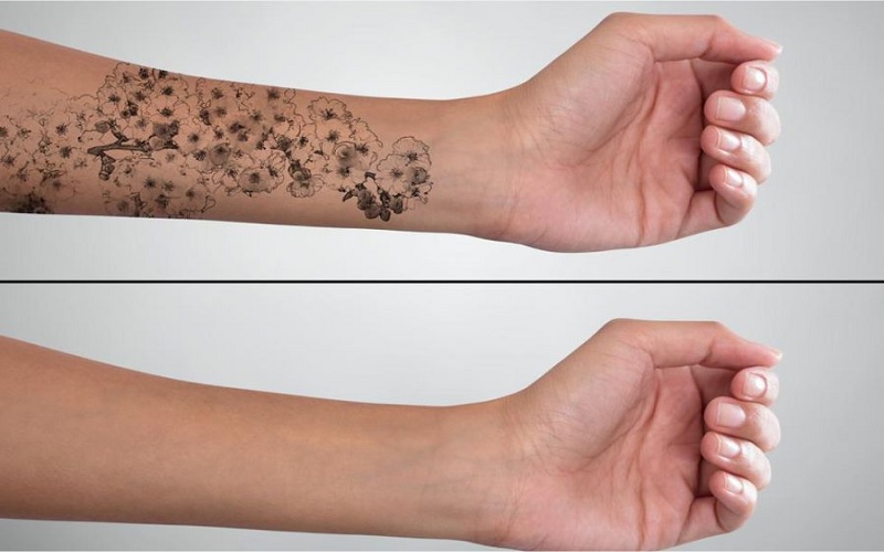 پاک کردن تاتو روی پوست تیره: آیا لیزر روی پوست شما جواب میدهد؟ 2 تت