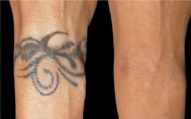 پاک کردن تاتو روی پوست تیره: آیا لیزر روی پوست شما جواب میدهد؟ 3 لیزر مناسب برای پاک کردن تاتوهای رنگی