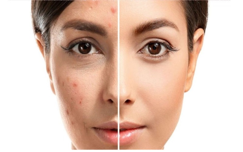 بهترین محصولات درمان جوش و روشهای مراقبت از پوست مستعد جوش 2 بهترین محصولات درمان جوش