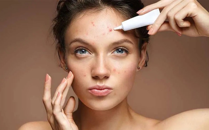 سالیسیلیک اسید: آیا برای درمان جوش موثر است؟ 3 سالیسیلیک اسید و درمان جای جوش