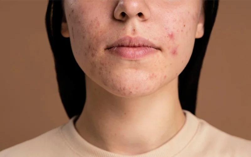 ارتباط سولاریوم با جوش صورت 2 خطرات سولاریوم فراتر از جوش