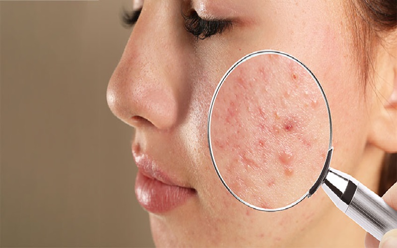 ارتباط سولاریوم با جوش صورت 3 درمان مشکلات باقیمانده از آکنه