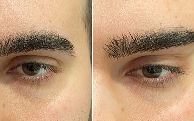 همه چیز درباره دستگاه لیزر ADVATX 2 ثثثثثث