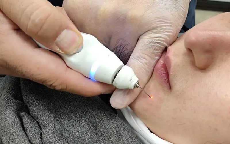 راهنمای کامل مراقبت بعد از برداشتن خال 1 چرامراقبت بعد از برداشتن خال اهمیت دارد؟