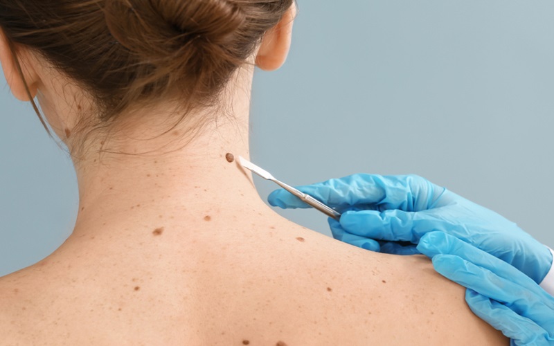 راهنمای کامل مراقبت بعد از برداشتن خال 2 مراحل مهم مراقبت بعد از برداشتن خال