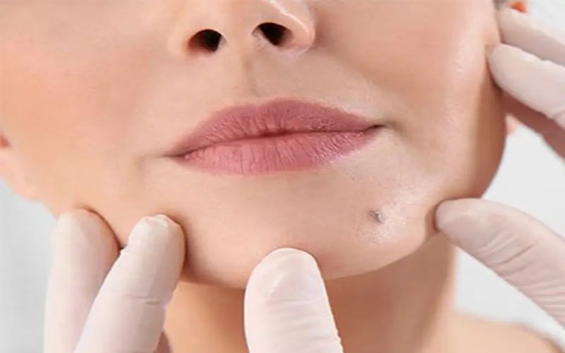 راهنمای کامل مراقبت بعد از برداشتن خال 3 نکات تکمیلی برای مراقبت بعد از برداشتن خال