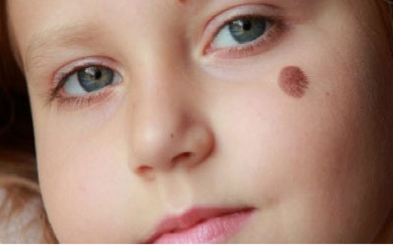 انواع خال که باید بشناسید 1 خالهای مادرزادی و اکتسابی