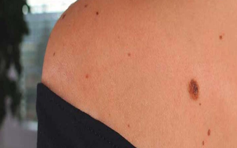 انواع خال که باید بشناسید 2 خالهای معمولی (Melanocytic Nevi)