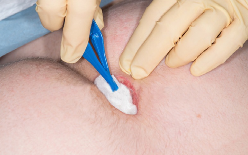 روش های درمان کیست مویی: از جراحی تا لیزر و درمان خانگی 1 کیست مویی چیست و چه علائمی دارد؟