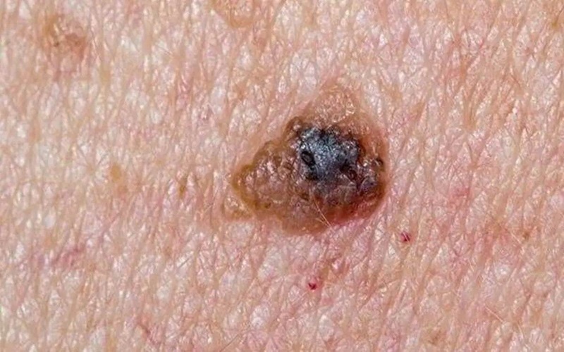 خال سرطانی چیست؟ علائم و تشخیص 3 سایر انواع سرطان پوست