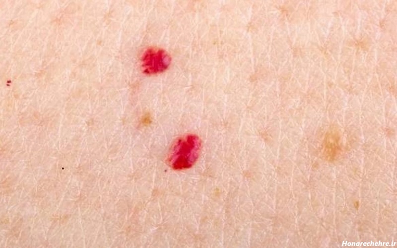 خال سرطانی چیست؟ علائم و تشخیص 2 شدت و خطر سرطان پوست