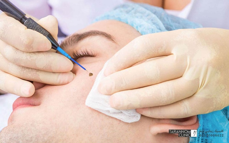 آیا برداشتن خال باعث ایجاد اسکار میشود؟ 3 عوامل مؤثر در ایجاد اسکار بعد از برداشتن خال