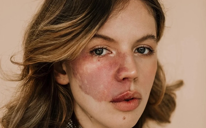 راهنمای جامع انواع و درمان خال ماه گرفتگی 2 خال ماه گرفتگی چیست؟