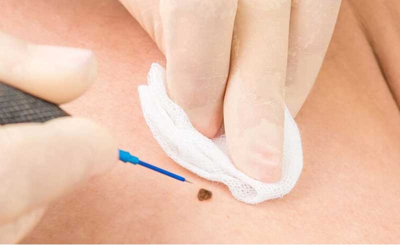 آیا برداشتن خال باعث ایجاد اسکار میشود؟ 2 انواع روشهای برداشتن خال و تأثیر آنها بر ایجاد اسکار