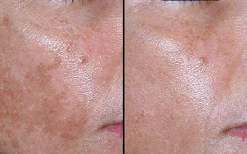 درمان ماه گرفتگی با لیزر 1 درمان ماه گرفتگی با لیزر چیست؟