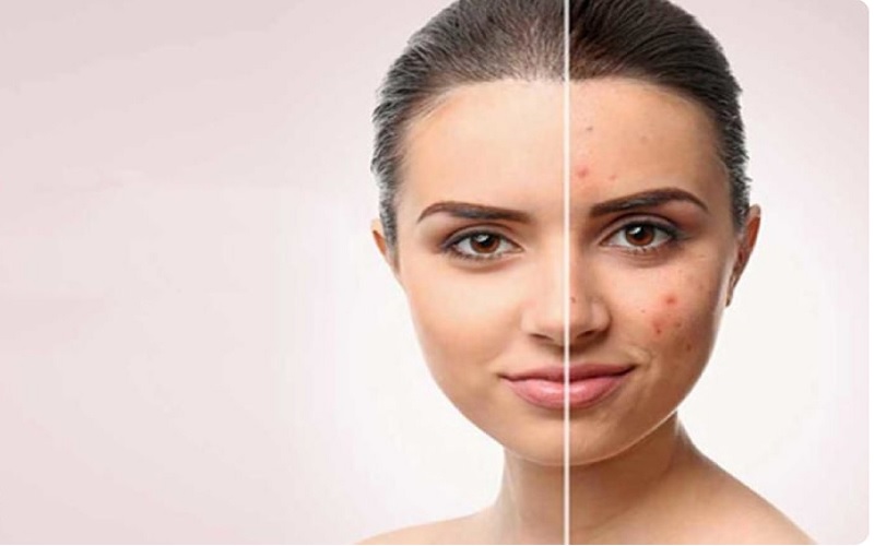 مورفئوس ۸ برای جای جوش 1 جای جوش چیست و چرا درمان آن مهم است؟