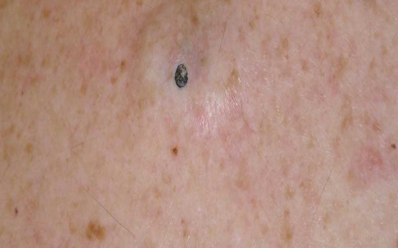 همه چیز درباره جوش سر سیاه و راههای درمان آن 3 نکات پیشگیری از جوش سر سیاه