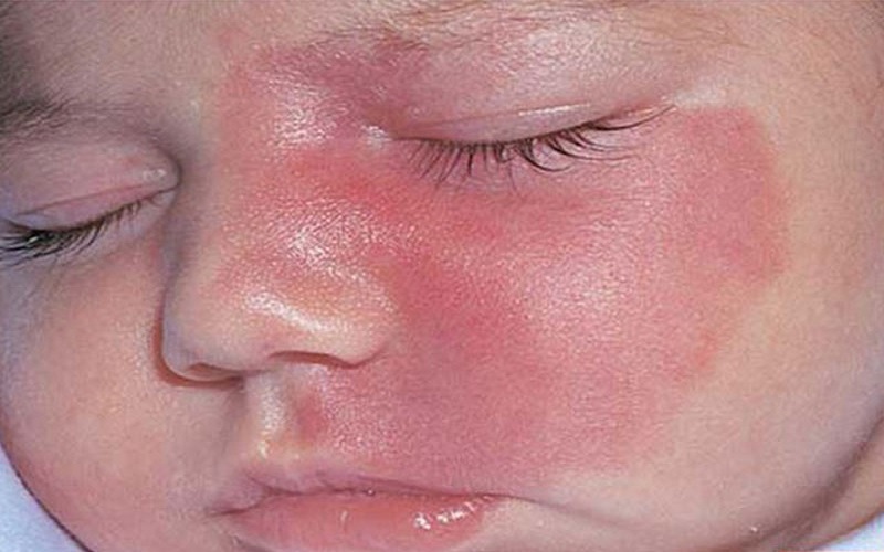 درمان ماه گرفتگی با لیزر 2 پپ 1