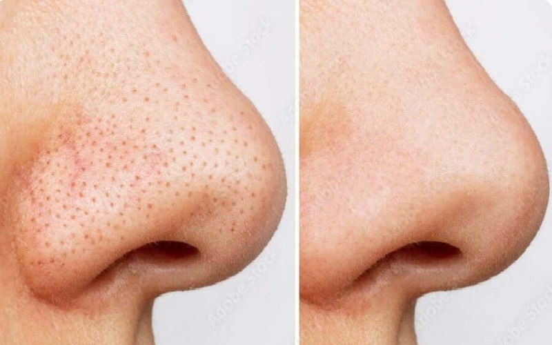 همه چیز درباره جوش سر سیاه و راههای درمان آن 2 روشهای درمان جوش سر سیاه