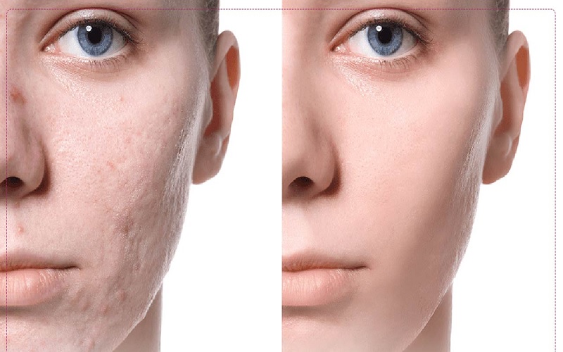 مورفئوس ۸ برای جای جوش 3 بهبود قابل توجه جای جوش با مورفئوس ۸