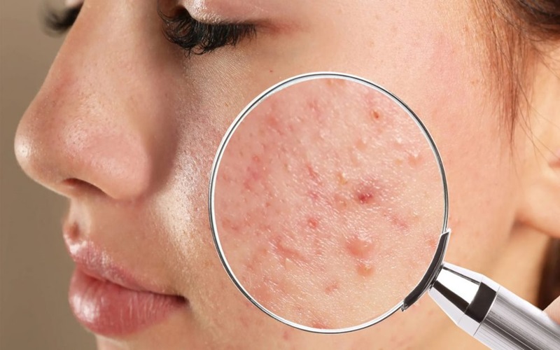 نقشه جوش صورت: علل و درمان جوش در هر ناحیه از صورت 3 پیشگیری و مراقبت کلی برای جوش صورت