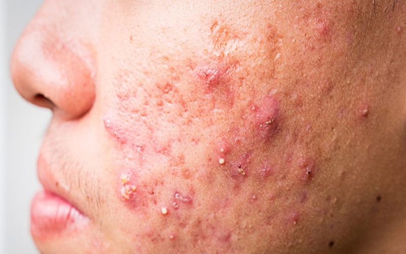 نقشه جوش صورت: علل و درمان جوش در هر ناحیه از صورت 1 پیشانی و جوش صورت