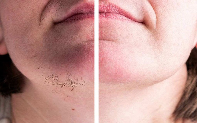 درمان قطعی موهای زائد ناشی از تنبلی تخمدان با لیزر 2 لیزر درمانی بر موهای زائد ناشی از تنبلی تخمدان