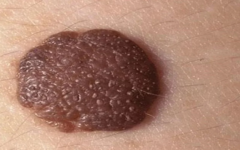 انواع خال که باید بشناسید 3 چ