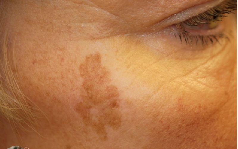انواع خال که باید بشناسید 5 خالهای پوستی ناشی از افزایش سن (Lentigines)