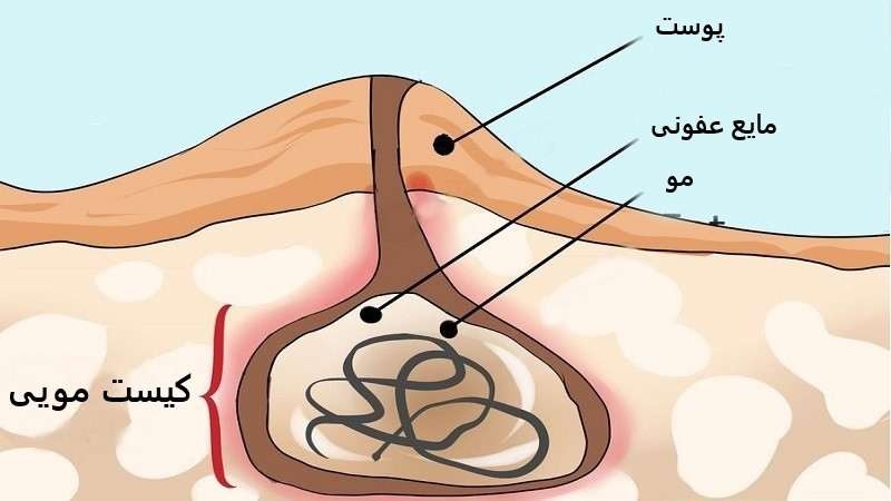 درمان کیست مویی با لیزر 9 کیست مویی چیست؟