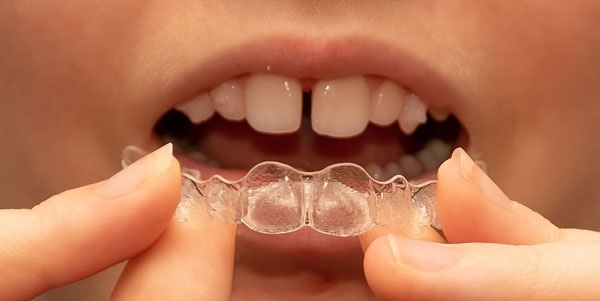 اینویزیلاین برای کودکان