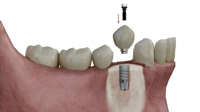 افتادن ایمپلنت دندان