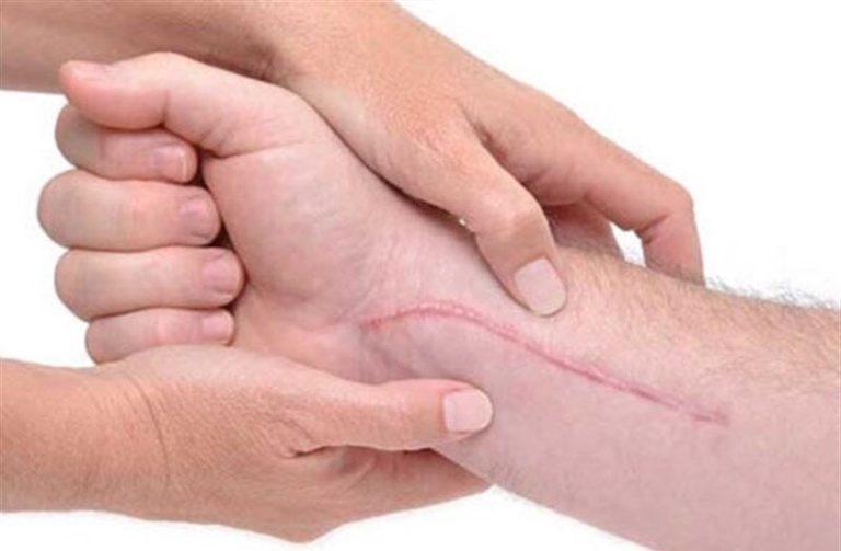 رفع جای زخم با درماتولوژی