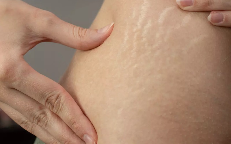 راهنمای جامع درمان ترک پوستی 1 علتهای ایجاد ترک پوستی