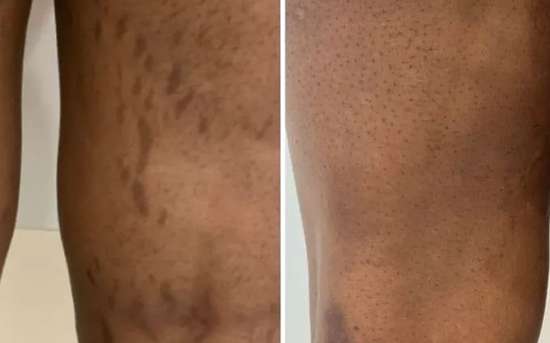 راهنمای جامع درمان ترک پوستی 2 محصولات طبیعی و خانگی برای درمان ترک پوستی