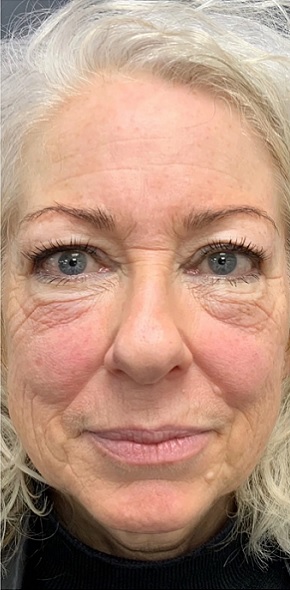 بلفاروپلاستی در اصفهان 5 1 1